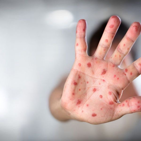 Suman 126 casos de sarampión en 10 municipios de Puebla, informa la Secretaría de Salud