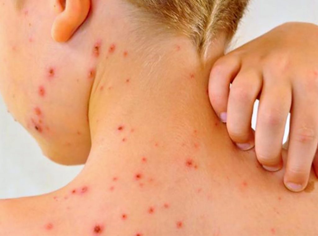 Aumentan los casos de sarampión en Puebla